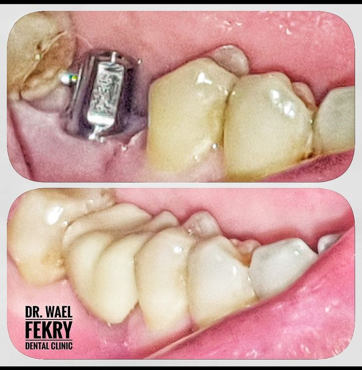 Dental Implant