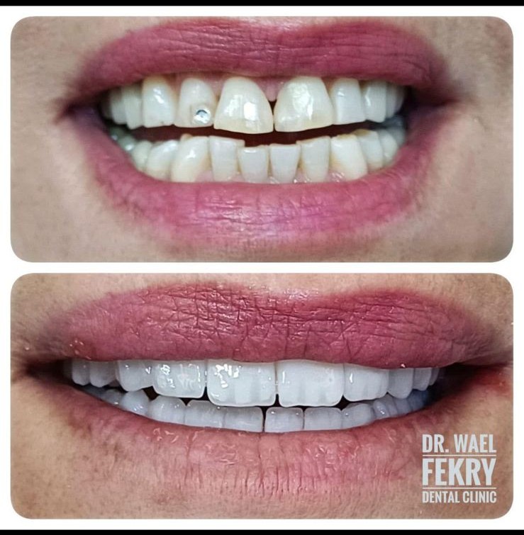 Smile Transformation